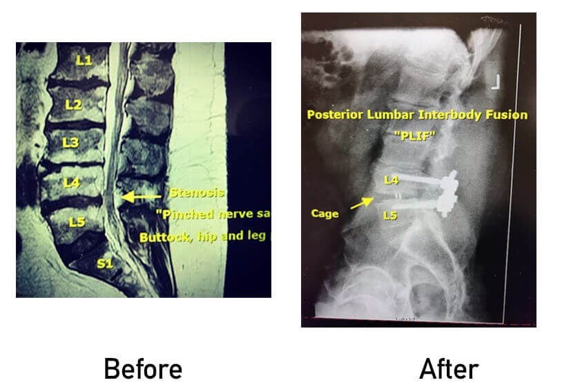 Mark - Posterior lateral interbody fusion (PLIF)